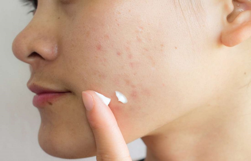 Acne scars: how to deal with them?