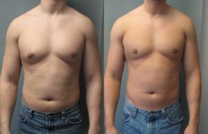 What Is Gynecomastia and How To Deal With It