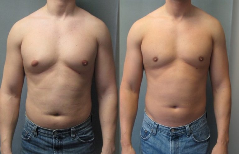 what-is-gynecomastia-and-how-to-deal-with-it